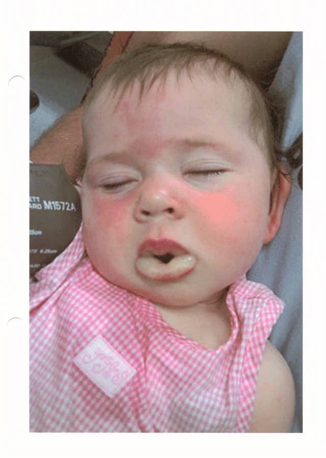 pictures of angioedema #11